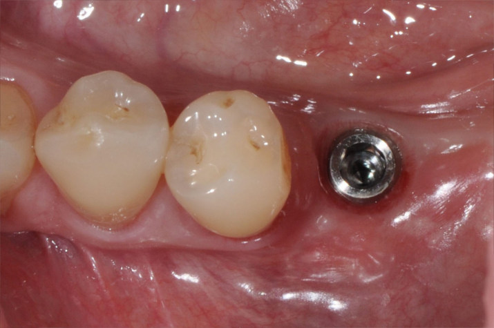 Zahnimplantat nach Implantation